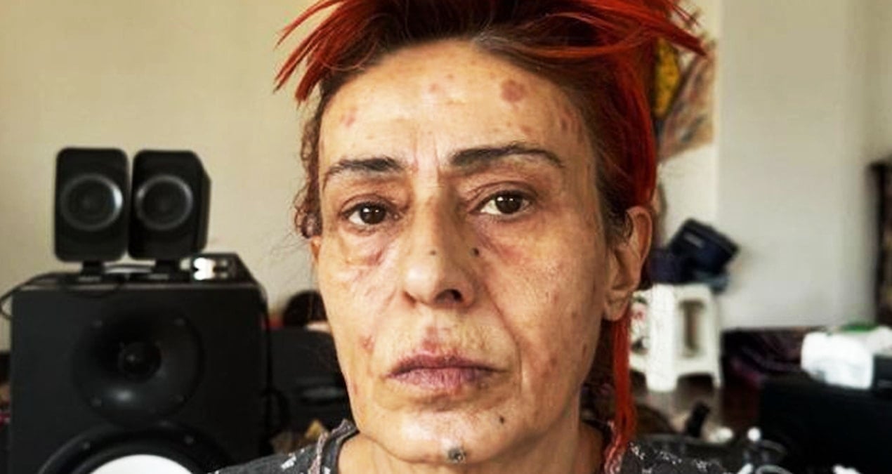 Saç boyası nedeniyle yüzünde yanıklar oluşmuştu… Yıldız Tilbe çareyi bunda buldu